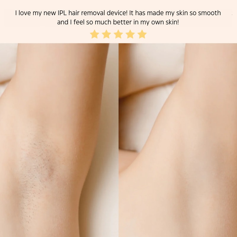 Laser Hair Removal System