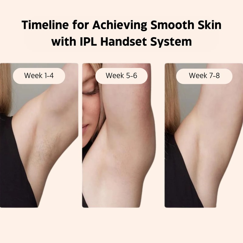 Laser Hair Removal System